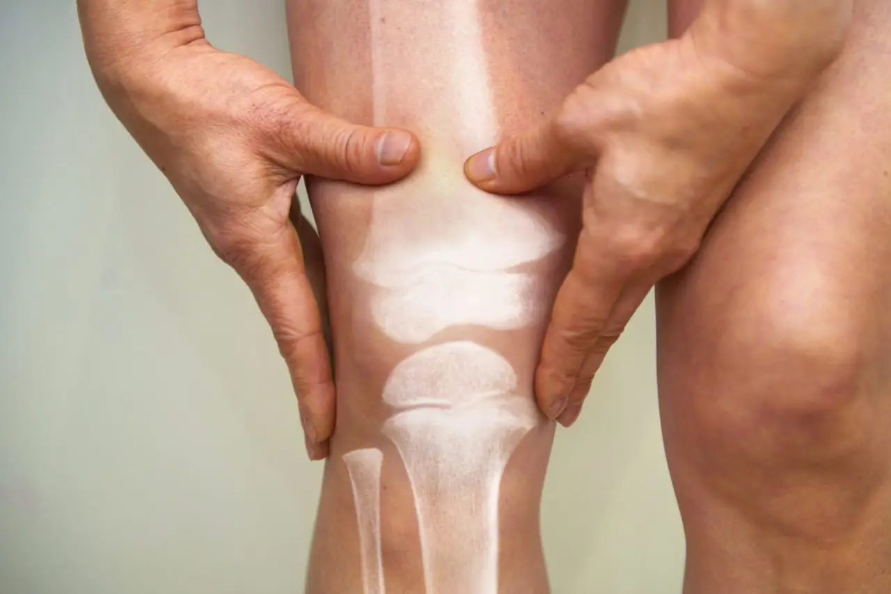 Osteoporosi: quali alimenti non devono mai mancare nella tua dieta quotidiana?